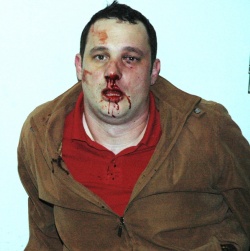 Jornalista Rodrigo Santos, após sofrer agressão em Joinville.  
